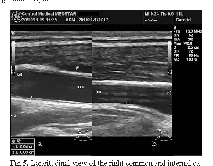 Figure 4 From Carotid Ultrasound. | Semantic Scholar Regarding Carotid Ultrasound Report Template